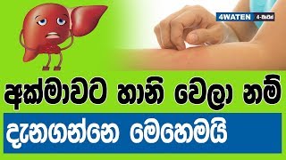 අක්මාවට හානි වෙලා නම් දැනගන්නෙ මෙහෙමයි  How to know your liver is damaging NEW 2019 [upl. by Ebenezer]