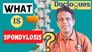 What is Spondylosis [upl. by Iinden]