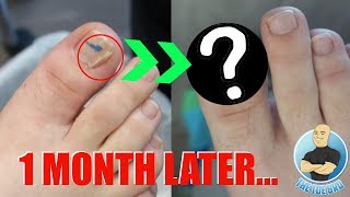 Did the Damaged Split Nail Heal FOOT HEALTH MONTH 2018 19 [upl. by Akram]