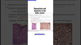 Hyperplasia and dysplasia in the body cancer [upl. by Ris]