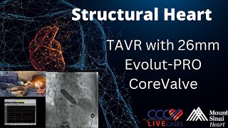 TAVR with 26mm EvolutPRO CoreValve  May 8 2018 [upl. by Janice506]