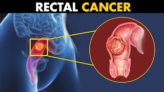 What Happens In Rectal Cancer  Symptoms Causes And Treatment [upl. by Egag118]