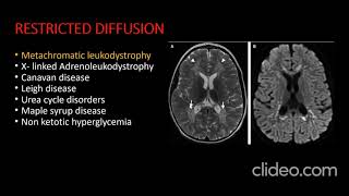 IMAGING APPROACH TO LEUKODYSTROPHIES [upl. by Sito]