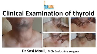 Clinical examination of thyroid swelling  An OSCE guide  MBBS MRCS  Surgery clinics [upl. by Iggy]