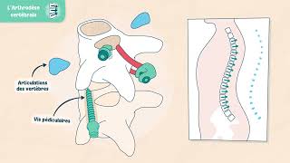 Les traitements de la scoliose  Larthrodèse vertébrale [upl. by Yggam]