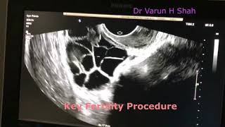 Oocyte retrieval  egg pickup   IVF procedure  Dr Varun H Shah  Inception [upl. by Enillebyam]