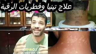 علاج التينيا والفطريات في الرقبة والجسم pityriasis versicolor [upl. by Akayas516]