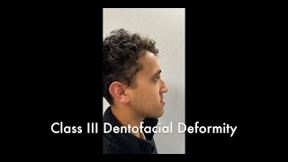 Bimaxillary Osteotomy and Genioplasty Part 1 [upl. by Rajiv]