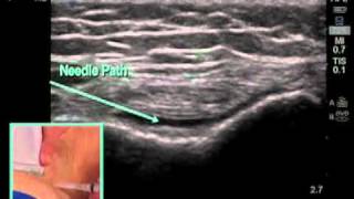 How to Ultrasound Guided Knee Injection Scanning Technique [upl. by Cantlon460]