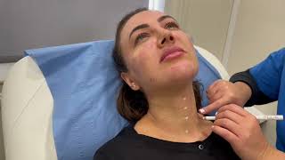 Profhilo Treatment on Face amp Neck [upl. by La Verne]