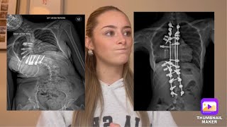 1 YEAR POST OP UPDATE  Scoliosis Surgery [upl. by Onitnatsnoc]