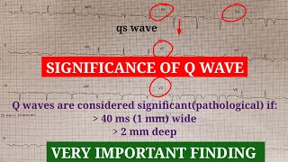 Pathological q wave diagnosis and ECG interpretation [upl. by Uzzial430]