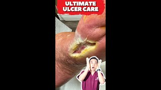 Ultimate Wound Care Diabetic Ulcer Grafting Transformation [upl. by Weber]