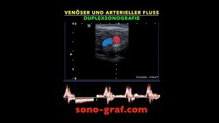 Duplexsonografie  Venöser und arterieller Fluss [upl. by Niletak]