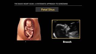 The Basic Fetal Heart Scan [upl. by Emad571]