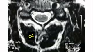 Spine Lecture How to Read a Cervical MRI [upl. by Peppie685]