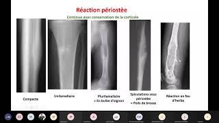 Visioconf  Imagerie  tumeurs osseuses et arthropathies [upl. by Clougher]