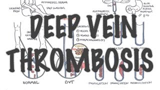 Deep Vein Thrombosis  Overview pathophysiology treatment complications [upl. by Jerrol]