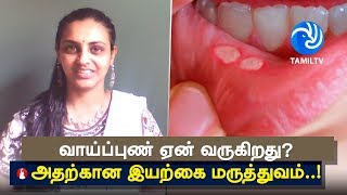 வாய்ப்புண் ஏன் வருகிறது அதற்கான இயற்கை மருத்துவம் Stomatitis Treatment  Tamil TV [upl. by Cohbath580]