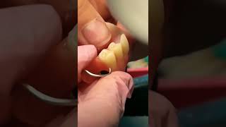 Polishing burs viralvideo dentist dentistryworld dentalcare satisfying dentaltreatment [upl. by Okiron800]