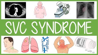 Superior Vena Cava Syndrome in 3 Minutes [upl. by Ateikan]