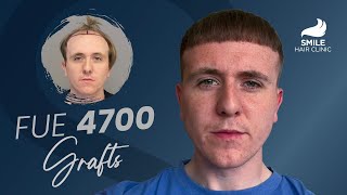 4700 Grafts Transformation  12Month Hair Transplant Results at Smile Hair Clinic [upl. by Ettenahs]