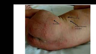 case 323 DDneonatal pustulosis transient neonatal pustular melanosis TNPM Erythema toxicum neonat [upl. by Negroj]