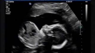 Ultrasound 23 Weeks [upl. by Nicoli]