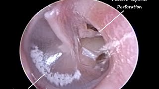 ENT Endoscopy  Chronic Sinusitis with Allergy causing left Eardrum peforation amp Tonsillitis [upl. by Leahcimnaes979]