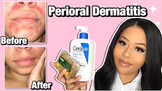 HOW I CLEARED MY PERIORAL DERMATITIS  Affordable Products [upl. by Eel]