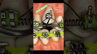 Glue the Dental Brackets Braces Etching [upl. by Mcspadden]