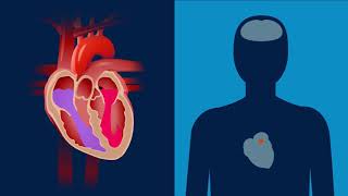 Was ist Vorhofflimmern  Erklärfilm  Medtronic [upl. by Cari]