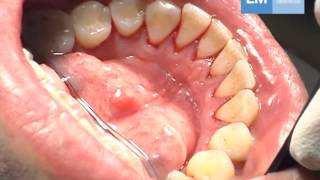 Periodontal treatment protocol [upl. by Sackman]