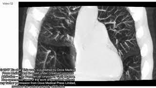 Hyperinflated lungs compress the heart during expiration in COPD  Sub ID 145599 SV2 [upl. by Royce]