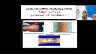 How can I differentiate between petechiae purpura and eecymosis bruises  platelet coagulation [upl. by Anaujait553]