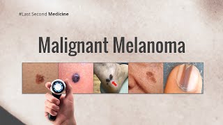 Malignant Melanoma [upl. by Kentigera294]