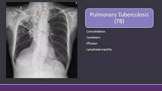 Chest Xray in Tuberculosis cxr TB radiology [upl. by Burtie]