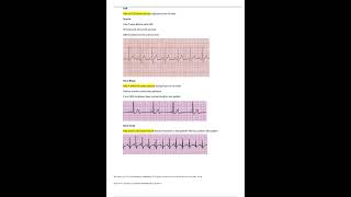 Relias Dysrhythmia Basic B Test 35 Questions and Answers 2023 [upl. by Gabbie]