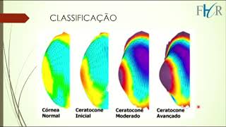 Ceratocone  Dra Tassiana Malagole E1FHR 2020 [upl. by Nnaitsirhc]