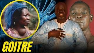 Goitre 1   Causes et Conséquences   Pr Ousmane Ndiaye  SAMA XALAAT TV [upl. by Nealey]