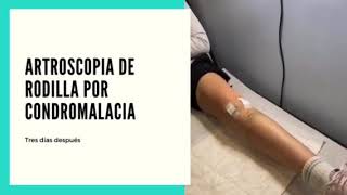 Artroscopia de rodilla por condromalacia en paciente joven [upl. by Albur942]