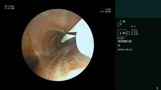 Endobronchial Lipoma  Bronchoscopic removal  Rigid Bronchoscopy  Snaring  Cryoextraction [upl. by Swann]