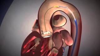 Advancing Aortic Stenosis Treatment Using TAVR with Dr Alan Malki [upl. by Alletse]