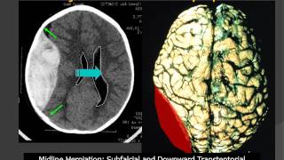 MedPix® Traumatic Brain Injury  Epidural Hematoma RadiologicPathologic Correlation [upl. by Nazar158]