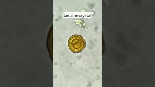 Leucine crystals in urine under microscopeurinalysismicroscopyurology [upl. by Renate]