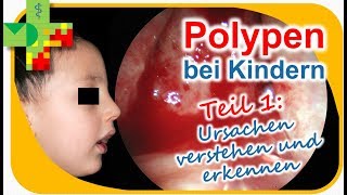 POLYPEN bei Kindern  Teil 1 [upl. by Pilif]