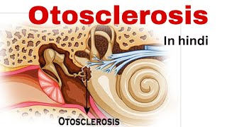 Otosclerosis nursing lecture in hindi  causetype symptoms treatmentsurgery  otosclerosis ent [upl. by Marwin]