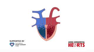 Ventricular Septal Defect [upl. by Atla182]