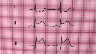 infarctus aigu et inferieur du myocarde [upl. by Vitoria92]