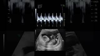 This is What a Babys Heartbeat Sounds Like During an Ultrasound science natal shorts [upl. by Paten233]